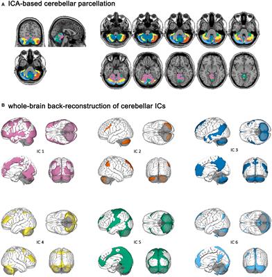 Cerebellar functional disruption and compensation in mesial temporal lobe epilepsy